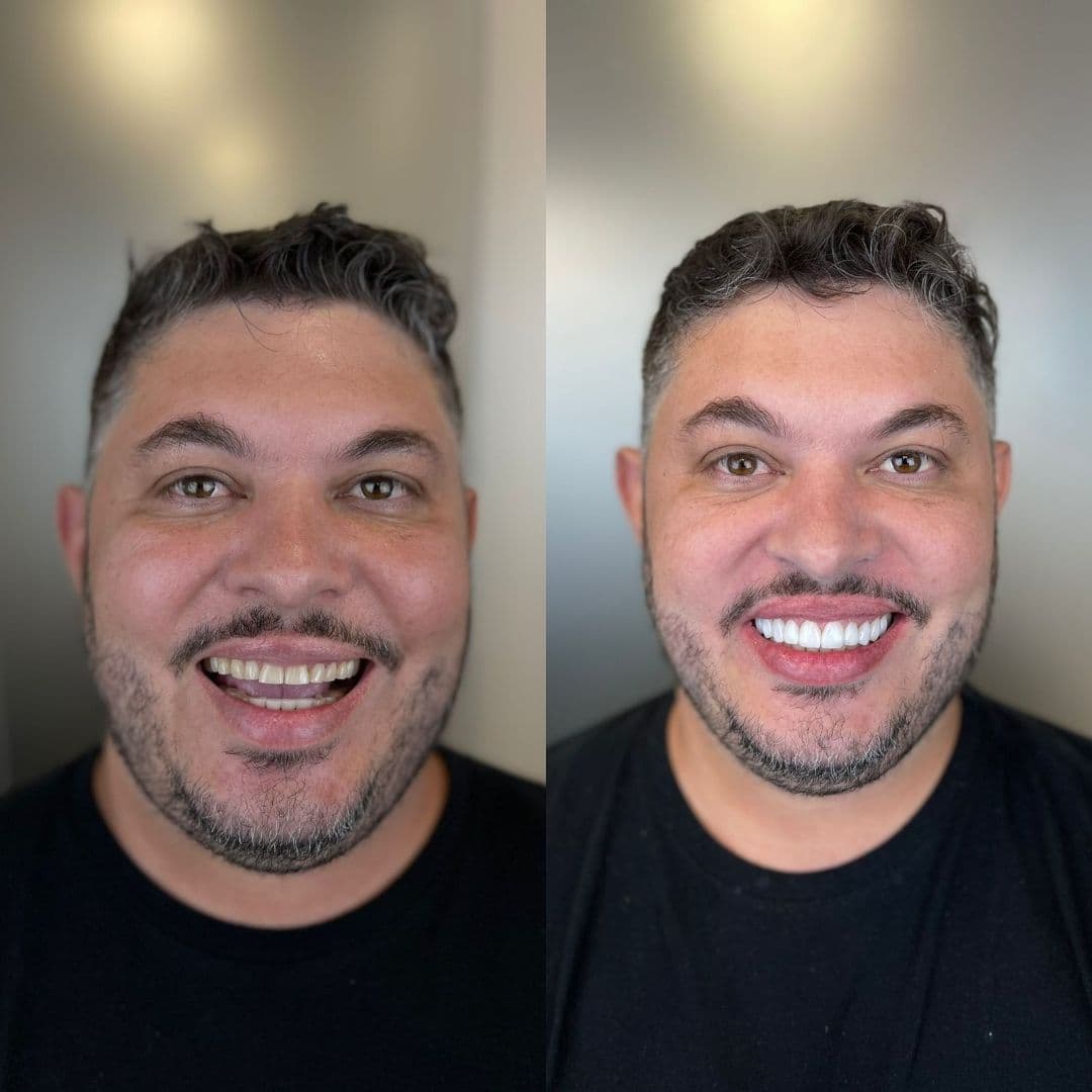 Antes e depois — Reabilitação estética