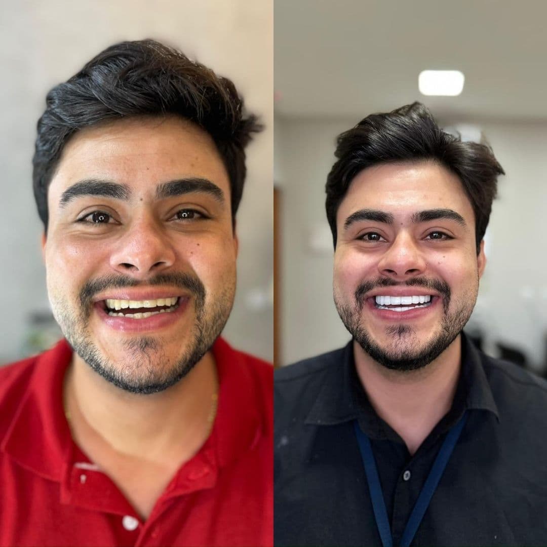 Antes e depois — Reabilitação estética