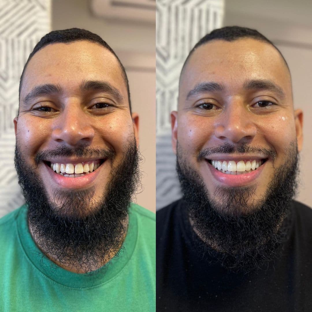 Antes e depois — Reabilitação estética