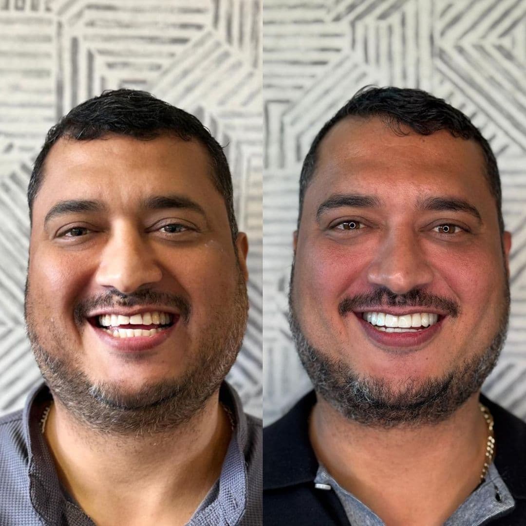 Antes e depois — Reabilitação estética