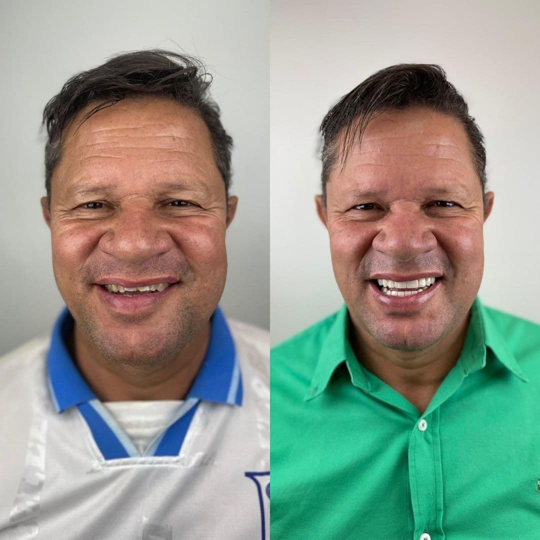 Antes e depois — Reabilitação estética