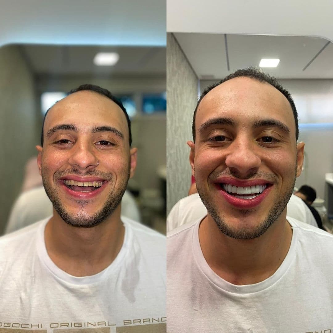Antes e depois — Reabilitação estética